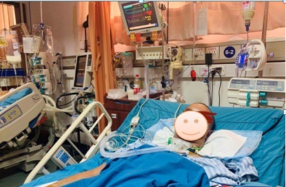 呼吸机|身上爬满红色蛛网，气道壁长出黑色锈斑，33岁的他遭遇生死劫，死里逃生