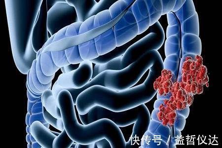 预防|大肠癌的早期症状有哪些 怎么预防大肠癌的发生