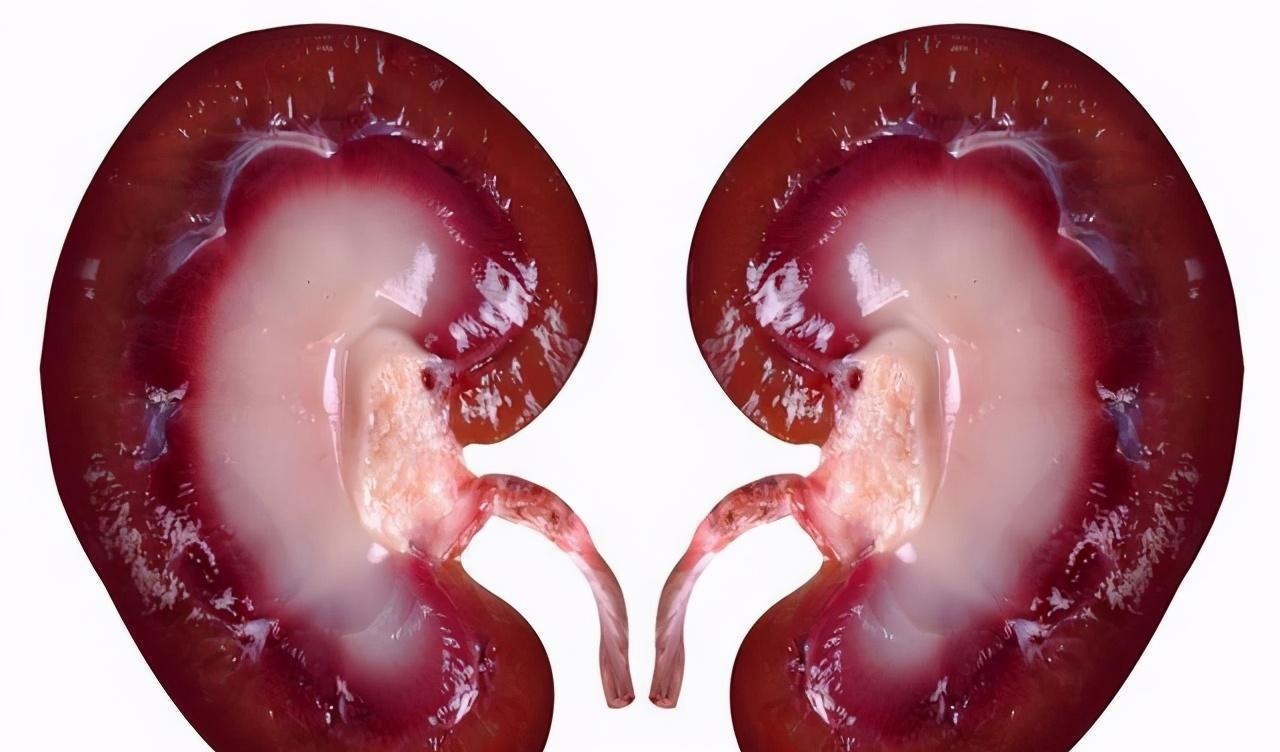 嘌呤|男子高尿酸变成肾衰竭，从不喝酒，医生指出2样东西害人不浅