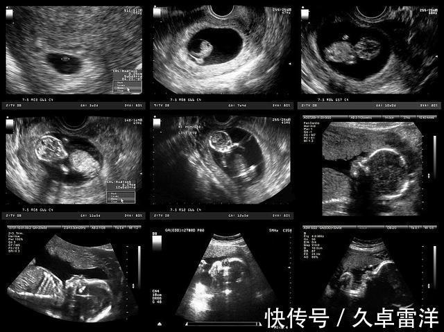 孩子|每次产检结果正常,孩子生出后发现畸形,医院需要负责吗