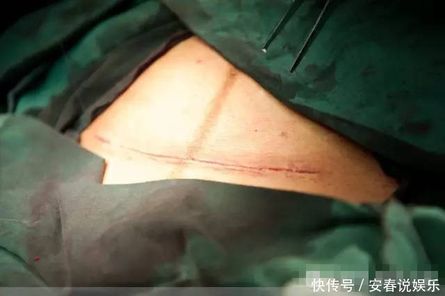 医生|剖腹产后没多久,肚子竟还是大如球,医生再次手术时也惊出一身汗