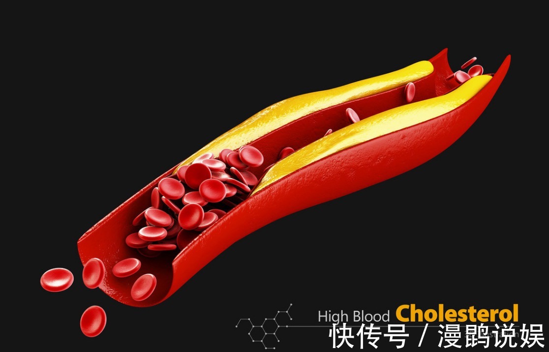 降血脂|高血脂降不下来1简单小招，不到1个月，血脂就降了、血管干净