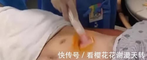 信号|肝硬化前有2个“危险信号”，肝不好及时自查，降低风险