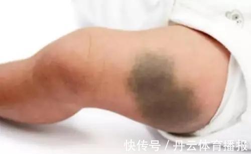 祸根|胎记长在哪里最有福气?恕我直言,2种胎记长哪都可能是祸根