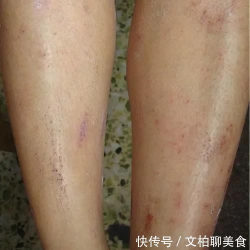 老年人|挠破皮也解决不了的老年人皮肤瘙痒，这几个方面您注意了吗？