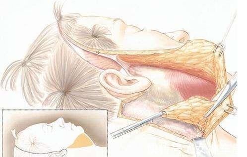 拉皮 46岁做拉皮手术是种什么体验，分享一下我的真实经历！