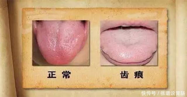 脾胃|珍贵舌诊:脾胃虚寒、胃阴不足、气滞血瘀的舌苔,看完记得存!