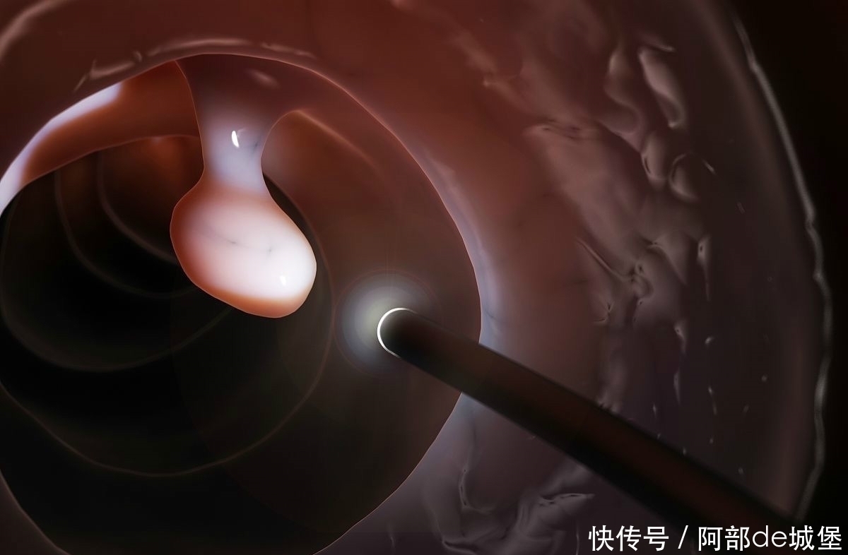 大肠癌|患上大肠癌的第一个信号,常常是这种异常,最好去检查一下