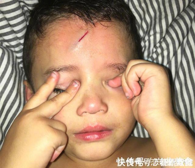 宝妈|男孩不小心磕破了额头,宝妈灵机一动,让娃变成了“哈利波特”