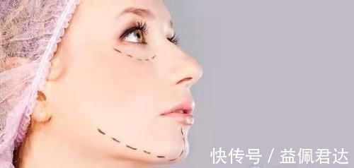 切口 闺蜜小切口提升后悔做了小拉皮手术没效果别眨眼睛看我小拉皮效果~