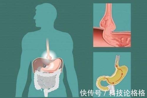 奥美拉唑|胃病靠治更靠养:老胃病调养除了奥美拉唑,中医还有几个方法