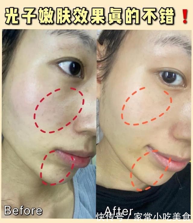 光子嫩肤 Dpl光子嫩肤效果怎么样!