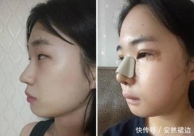 小脸确实更可爱,看完整容过程,只觉得满屏的疼痛