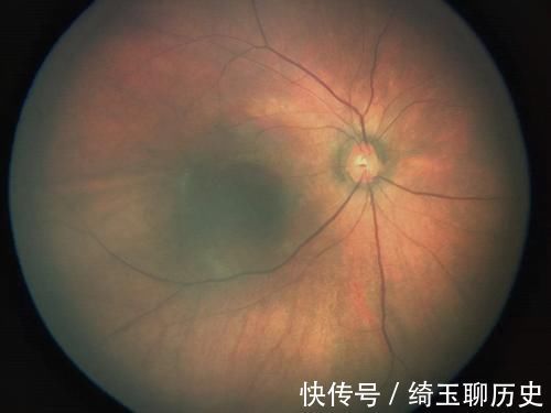 叶女士|双眼皮能揉出来?3岁男童视网膜脱落,只因妈妈的“双眼皮执念”