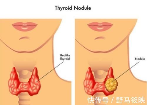 乳腺結節|甲狀腺結節、肺結節，體檢單上的結節距離“癌癥”還有多遠？
