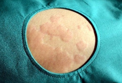 中药|七年荨麻疹，用一味中药就消了！我老师的“险招”值得研究