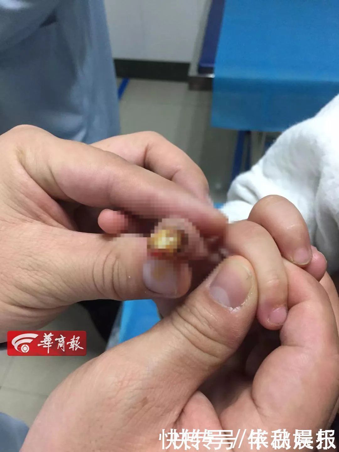 餐盘|2岁男童手指瞬间血肉模糊!一定要小心这种宝宝椅