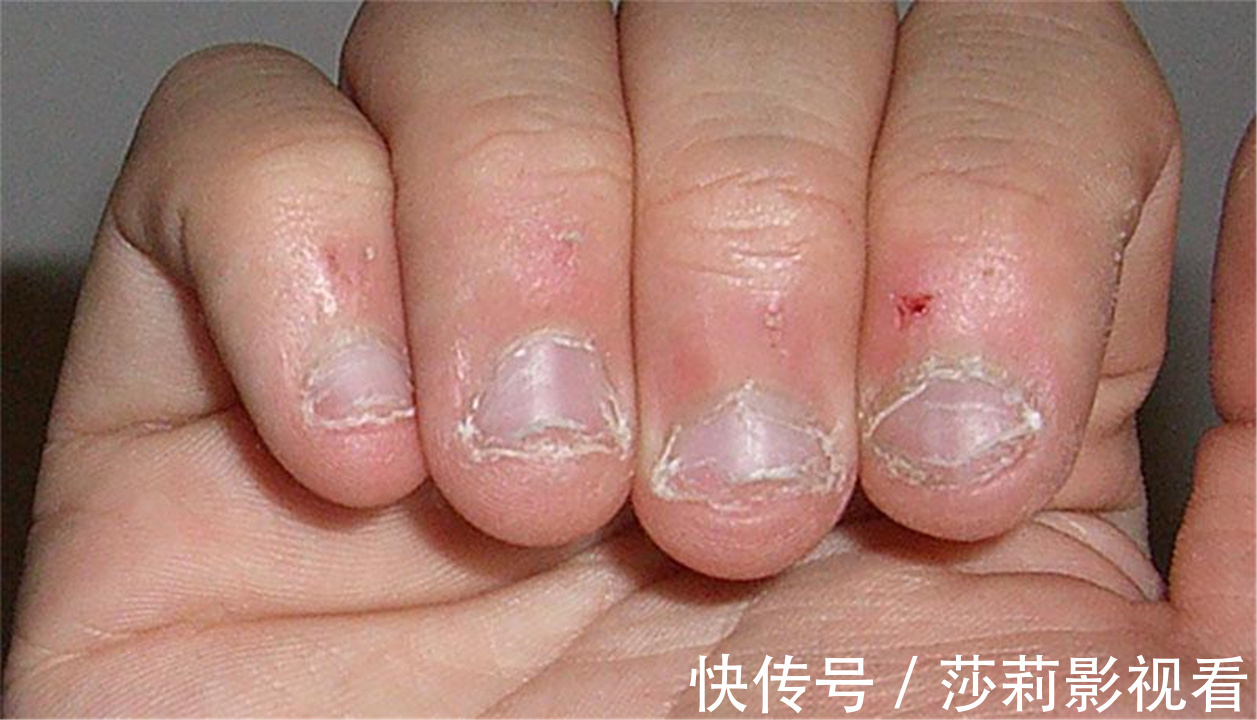 习惯|经常“啃指甲”的孩子,长大后往往逃不出这2种结局,父母要有数