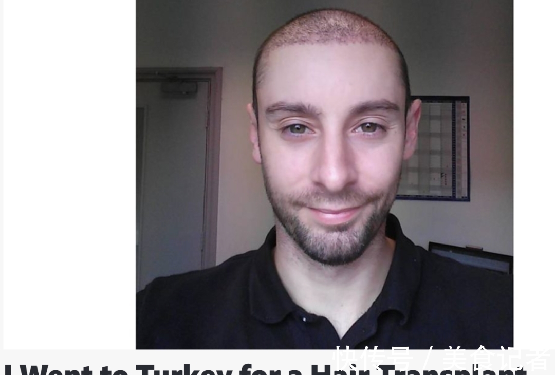 chris 每个月到底有多少人去土耳其植发?