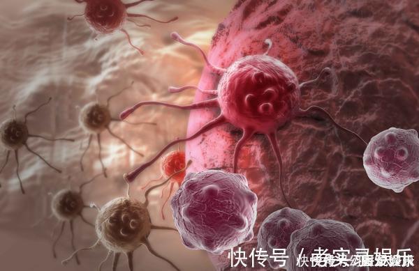 癌症|息肉和癌症有什么关系告诫3个部位长息肉,最好及时切除