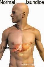 高龄|高龄老中医:肝出了问题, 基本都是肝癌晚期了,3大信号: 手上、脸上、嘴里全都有