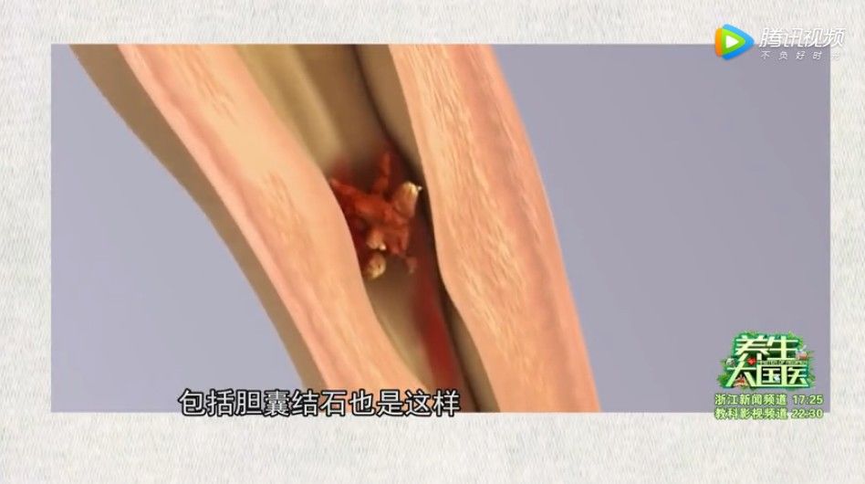 器官|这种隐藏在身体里的小石头是“沉默的杀手”，不痛不痒却能破坏整个器官！