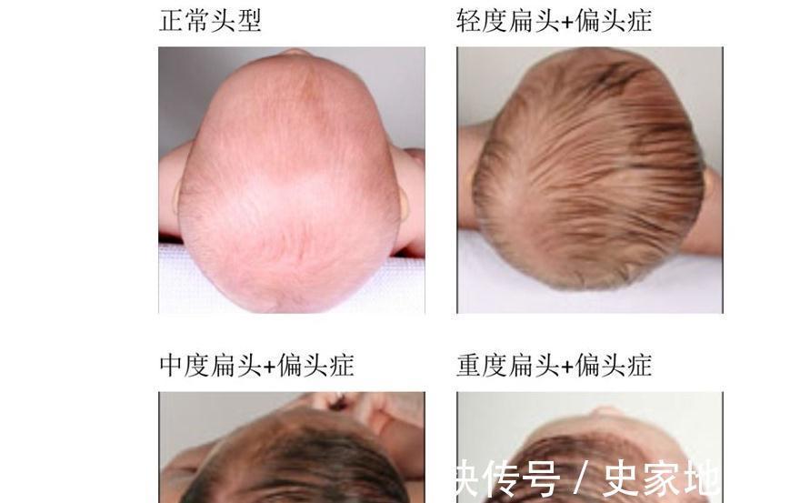 脑容量|宝宝睡觉时头总是偏向一边,要不要给他摆正?不懂的赶紧来看看!