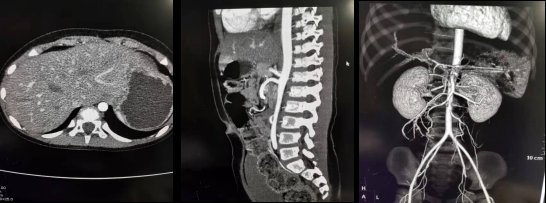 置针|做增强CT，为什么留置针的位置那么重要