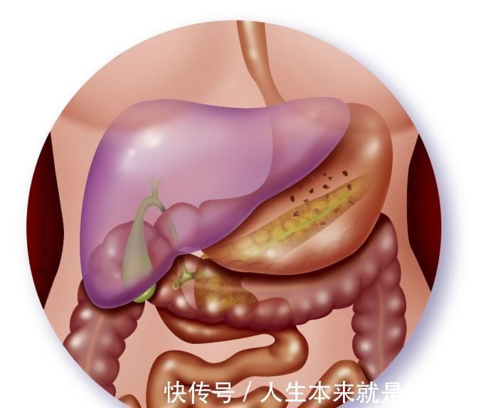 胰腺癌|胰腺癌恶性程度第一的癌症一个神奇药方,竟能挽救晚期患者