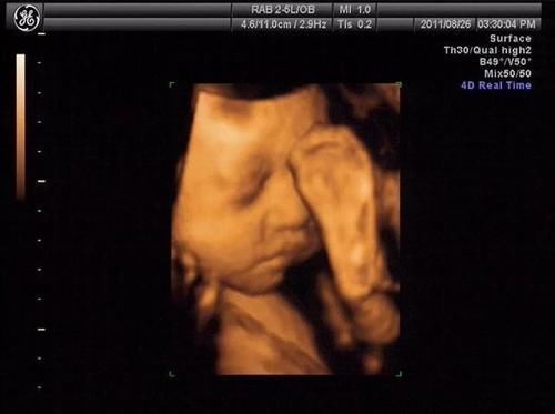 彩超|做四维医生说腹部脂肪厚,看不清,打出来单子也只能看宝宝大概面部怎么办?