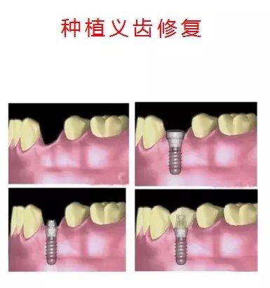 种植牙有哪些步骤？有何适应症与禁忌症|健康科普| 牙齿