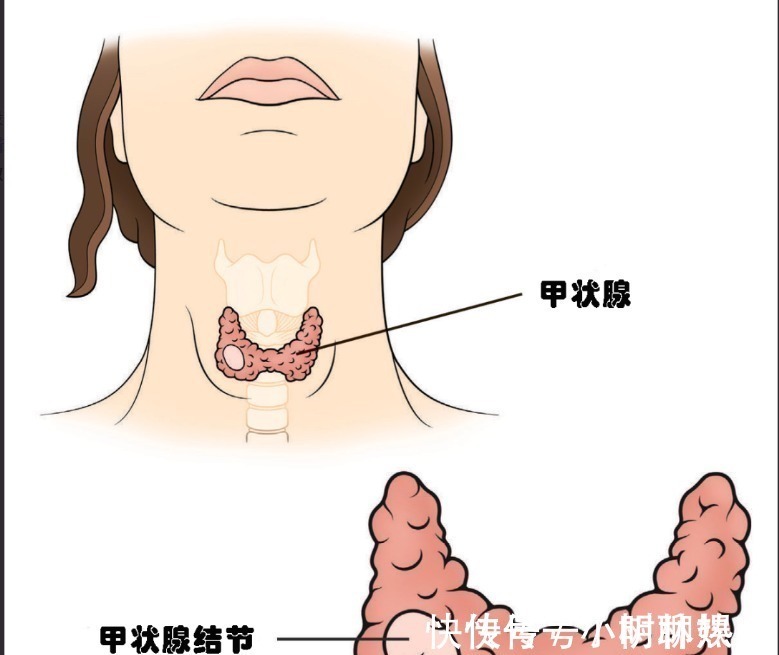 良性|结节、息肉、囊肿、增生哪个最可能癌变这么多年疑惑终于解开了