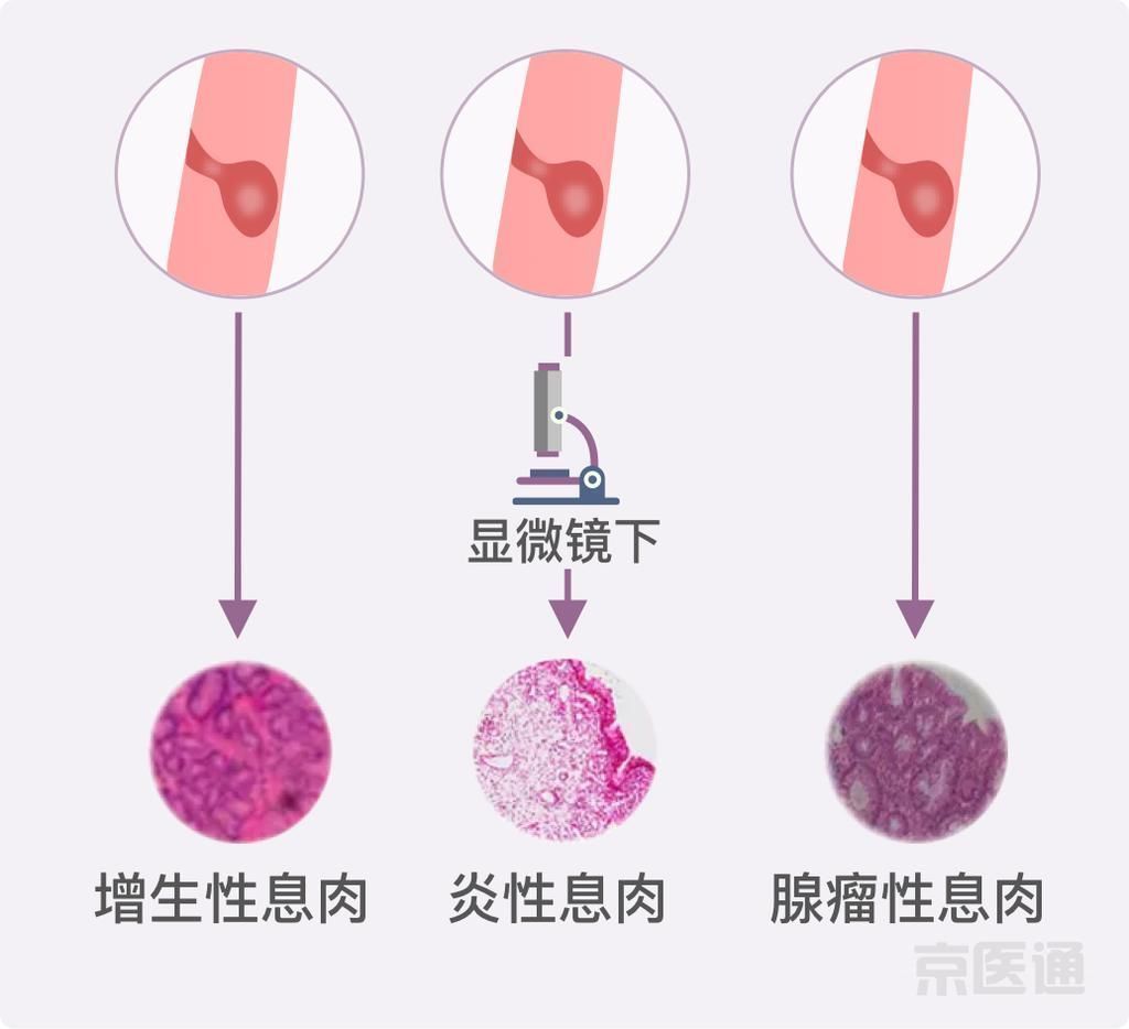 肝囊肿|结节、息肉、囊肿是癌症先兆吗?北肿专家们说出了真相!