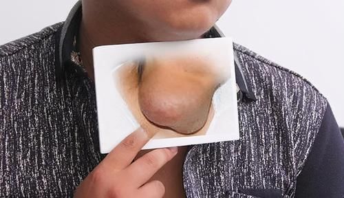 肿瘤|癌症多长时间不复发,算是治愈了?医生给出3个标准,你达标没?