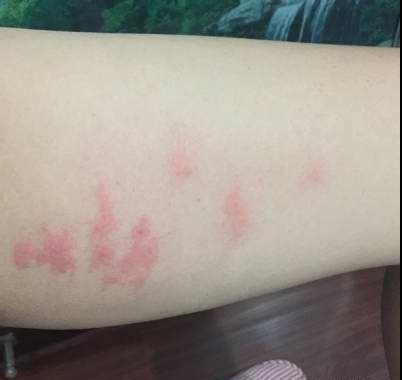 皮肤过敏|皮肤都很脆弱,过敏说来就来,远离它注意以下几点!