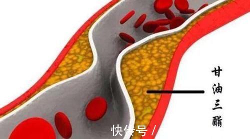 盐分|56岁男子，甘油三酯从18到1.8，医生：常吃一物，血管变通畅