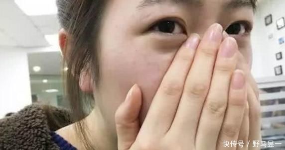 毛孔|鼻翼两侧挤出白色分泌物是啥?别再用手挤了,当心越来越多