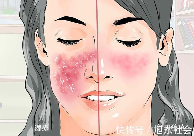 关节|红斑狼疮是不死的癌症,出现4个症状警惕红斑狼疮“上门”