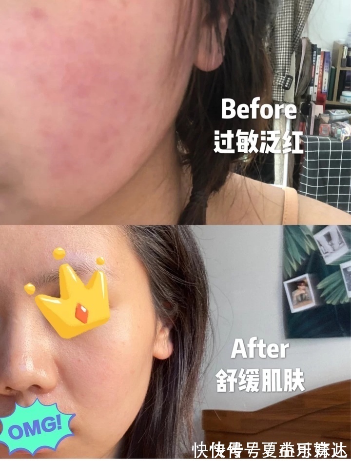 痘痘|已被拉入“黑名单”的护肤品,皮肤科医生都不敢用,孕妈还在囤?