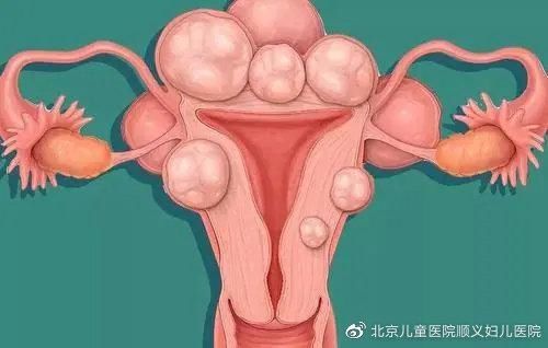 肌瘤|肌瘤折磨了一年，她就想回到从前