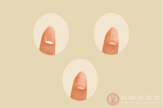 指甲里有细小短黑线怎么回事