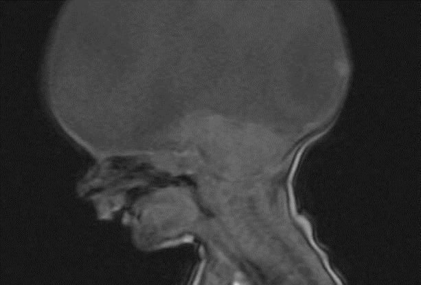 夫妇俩|男孩天生无大脑,医生断言很难存活,他的父母却让奇迹出现了