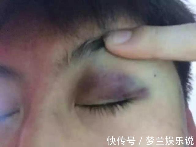 一条鱼没钓到,钓友被打出熊猫眼,围观者说:活该