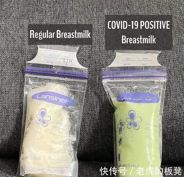 感染|外国一年轻妈妈产后母乳变成绿色,一查才知母子均感染了新冠肺炎