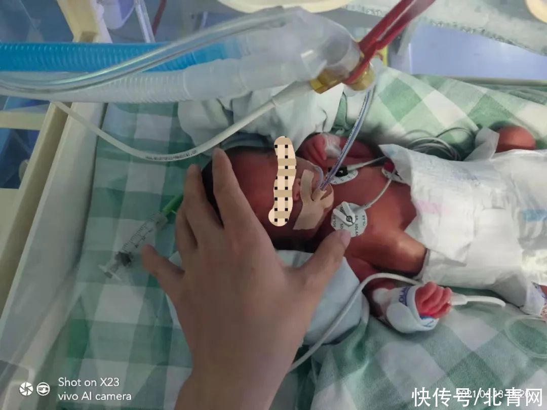 早产|在封闭区产房，三分钟抢回早产儿生命