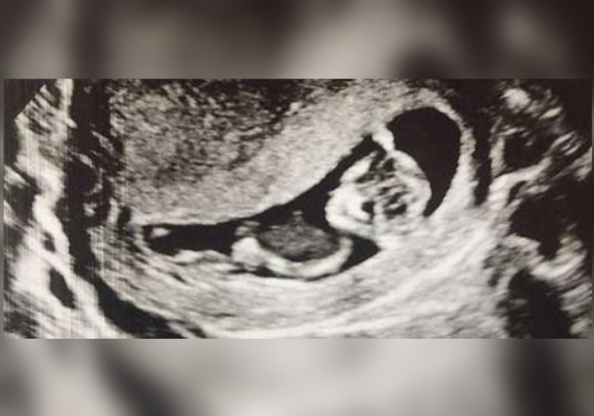 双胞胎|姐姐在腹中被弟弟“吸收”,化为胎记印在了弟弟腿上,爱的胎记