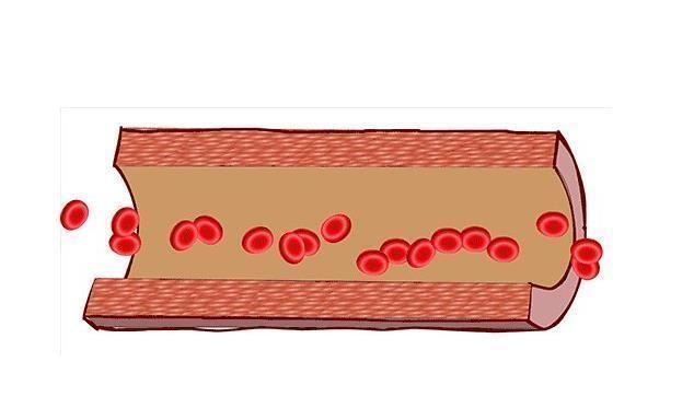 软化血管|软化血管的救星找到了，每天适当吃点，血管会慢慢变干净