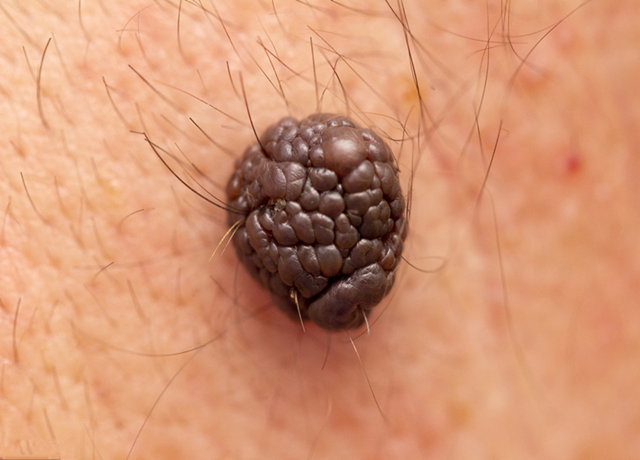 预防|癌症来降临前，大多伴有4种信号，教你3招，提前预防癌症