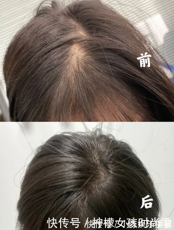 发际线|4款公认直呼好用的防脱洗发水,难怪别人发量惊人,看看你用过没