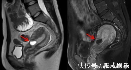 结扎|二胎剖腹产,要顺便“结扎”吗过来人只怪当年不懂里面的门道